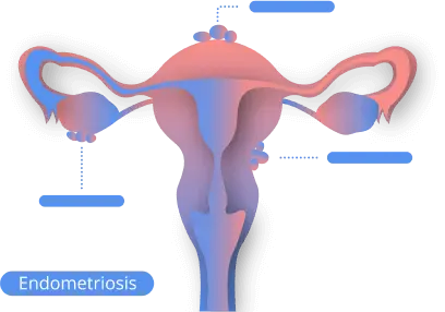 Endometriosis