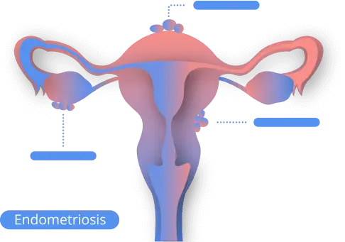 What is endometriosis?